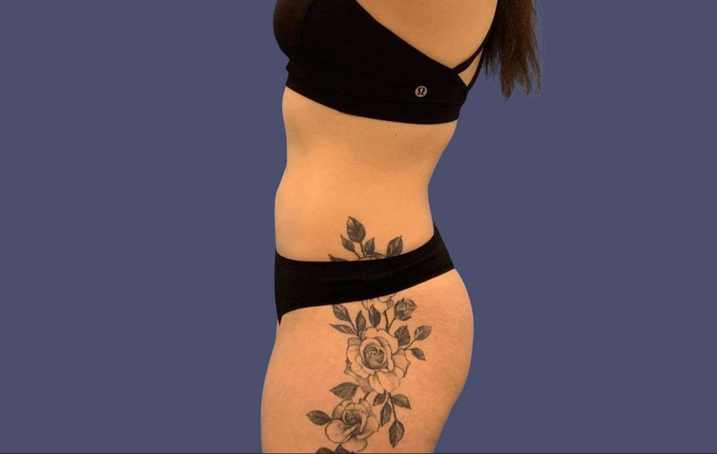 Liposuction 2 - Abdomen After