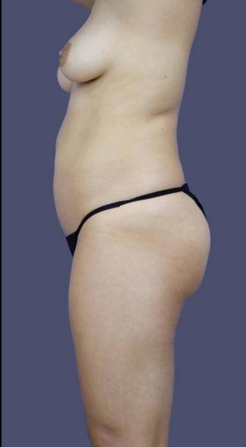 Liposuction 4 - Abdomen, Flanks, & Back Before
