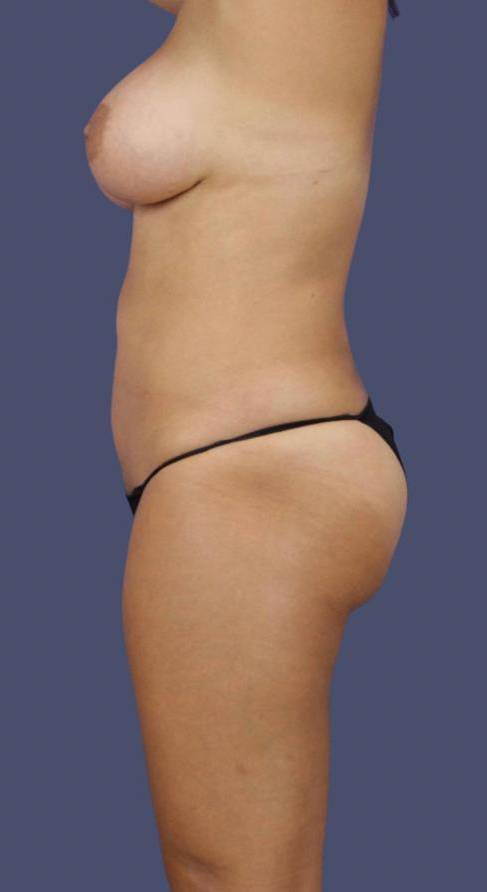 Liposuction 6 - Abdomen, Flanks, & Back After