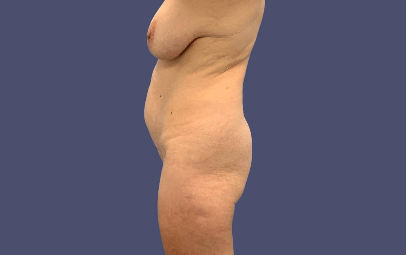 Liposuction 1 - Axilla, Abdomen, and Anterior Flanks Before