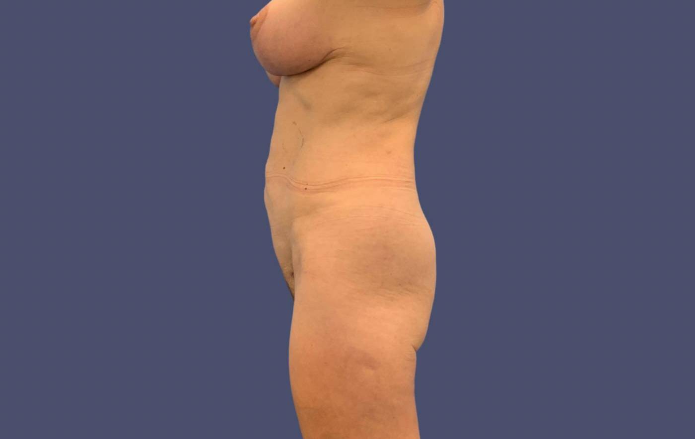 Liposuction 1 - Axilla, Abdomen, and Anterior Flanks After