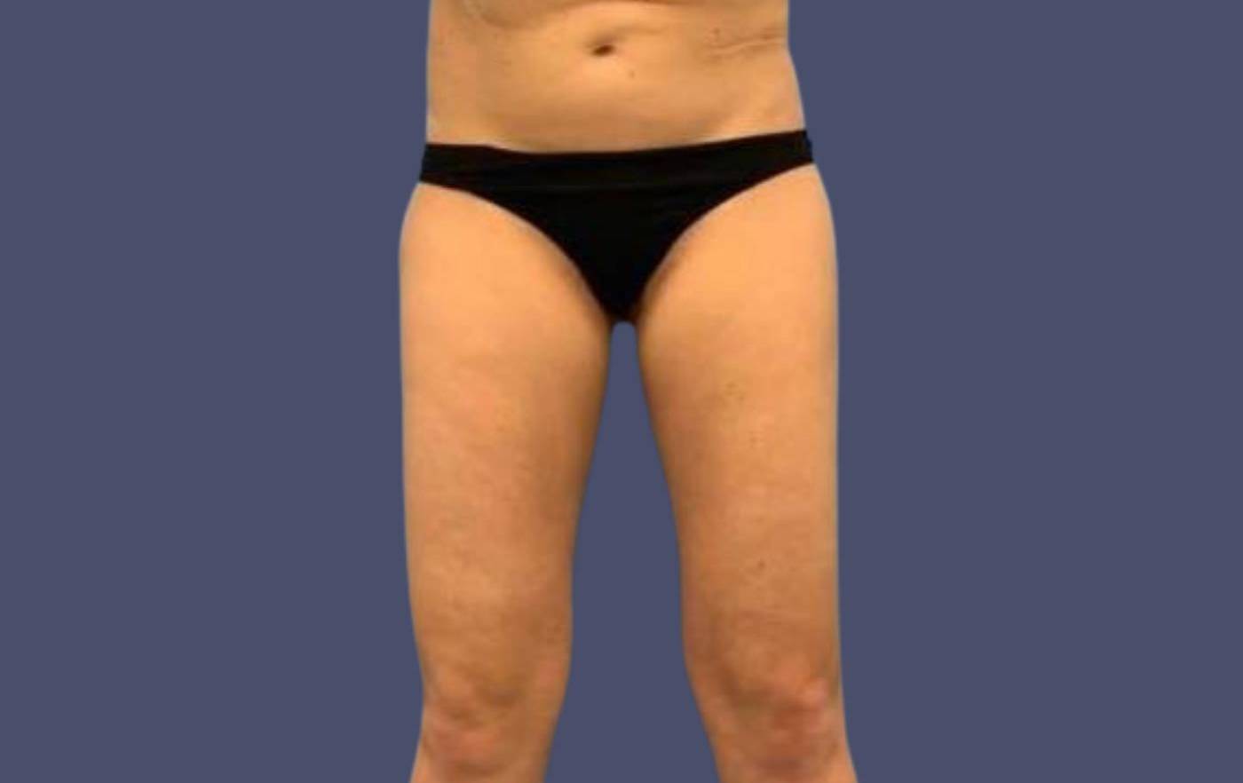 Liposuction 11 - Thighs Before