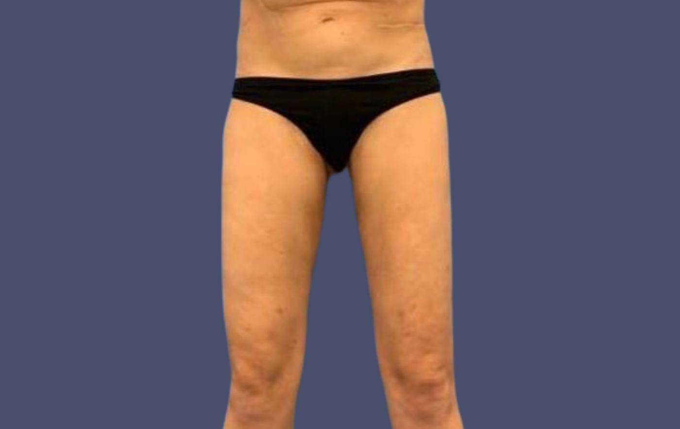 Liposuction 11 - Thighs After