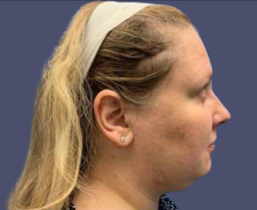 Submental Liposuction 4 Before