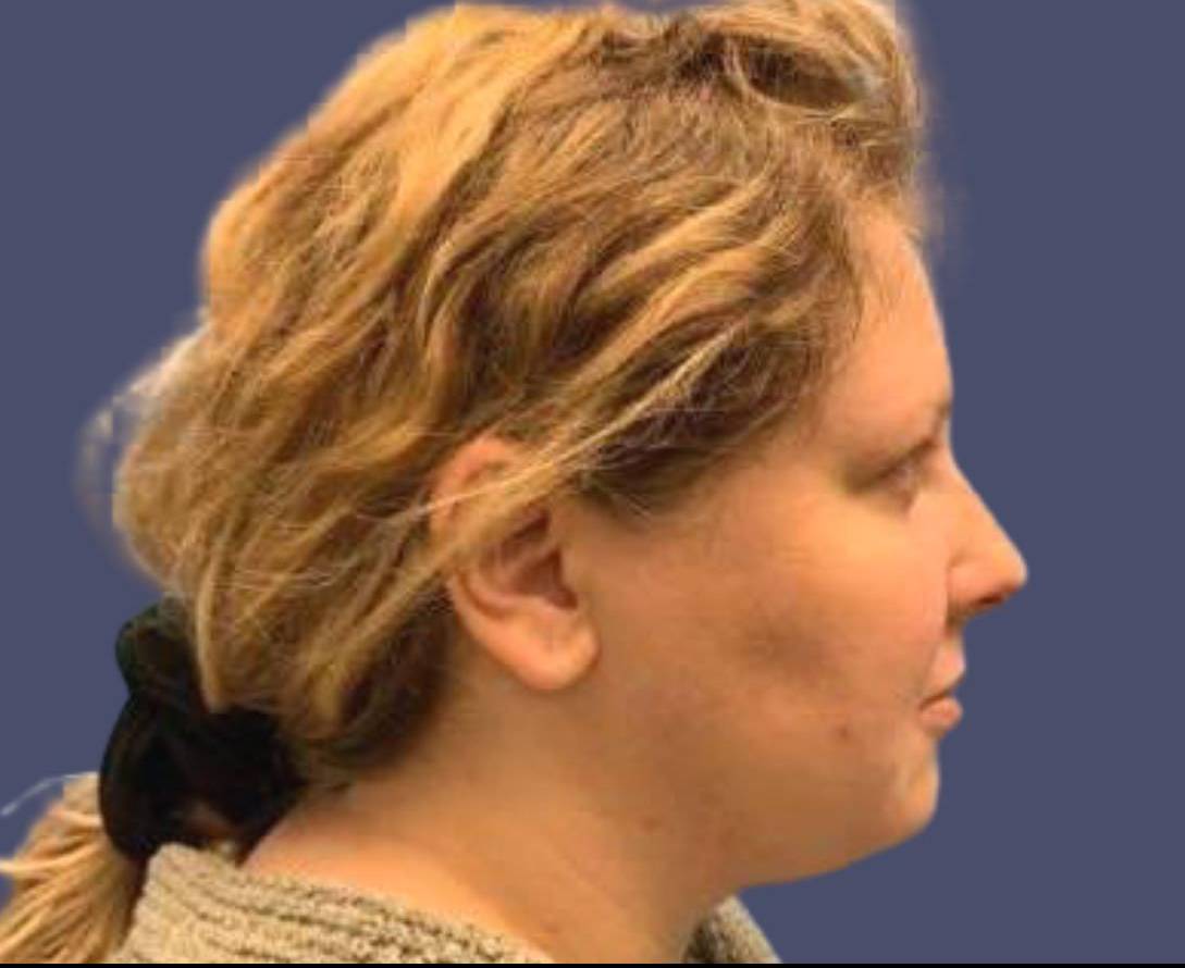 Submental Liposuction 4 After