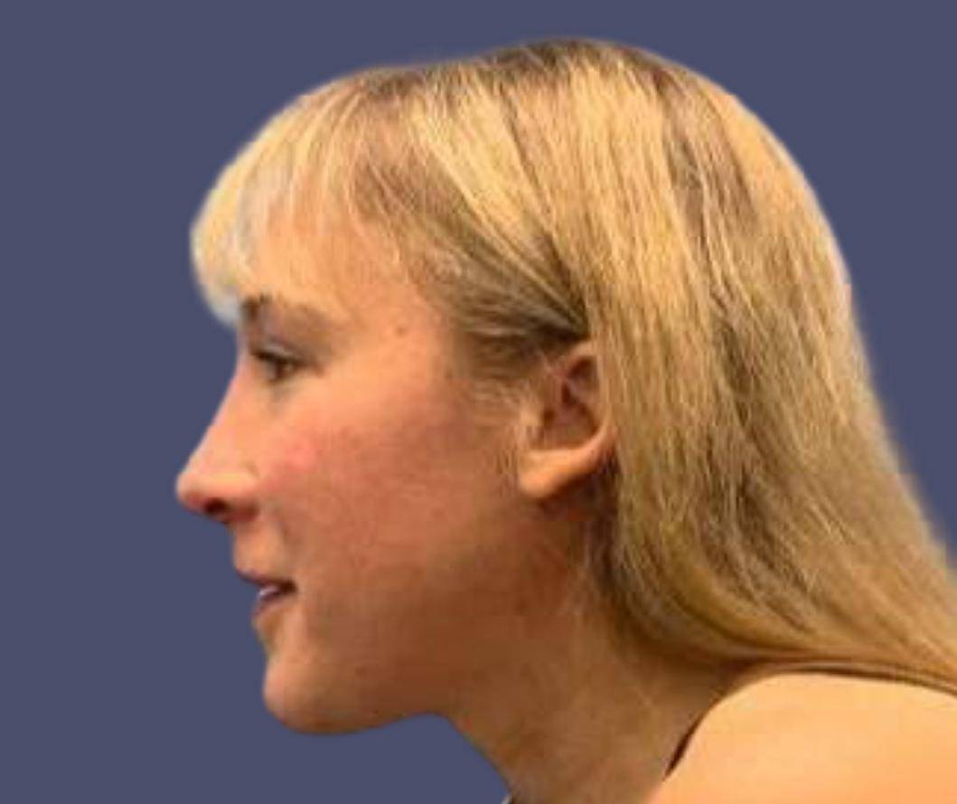 Submental Liposuction 3 Before