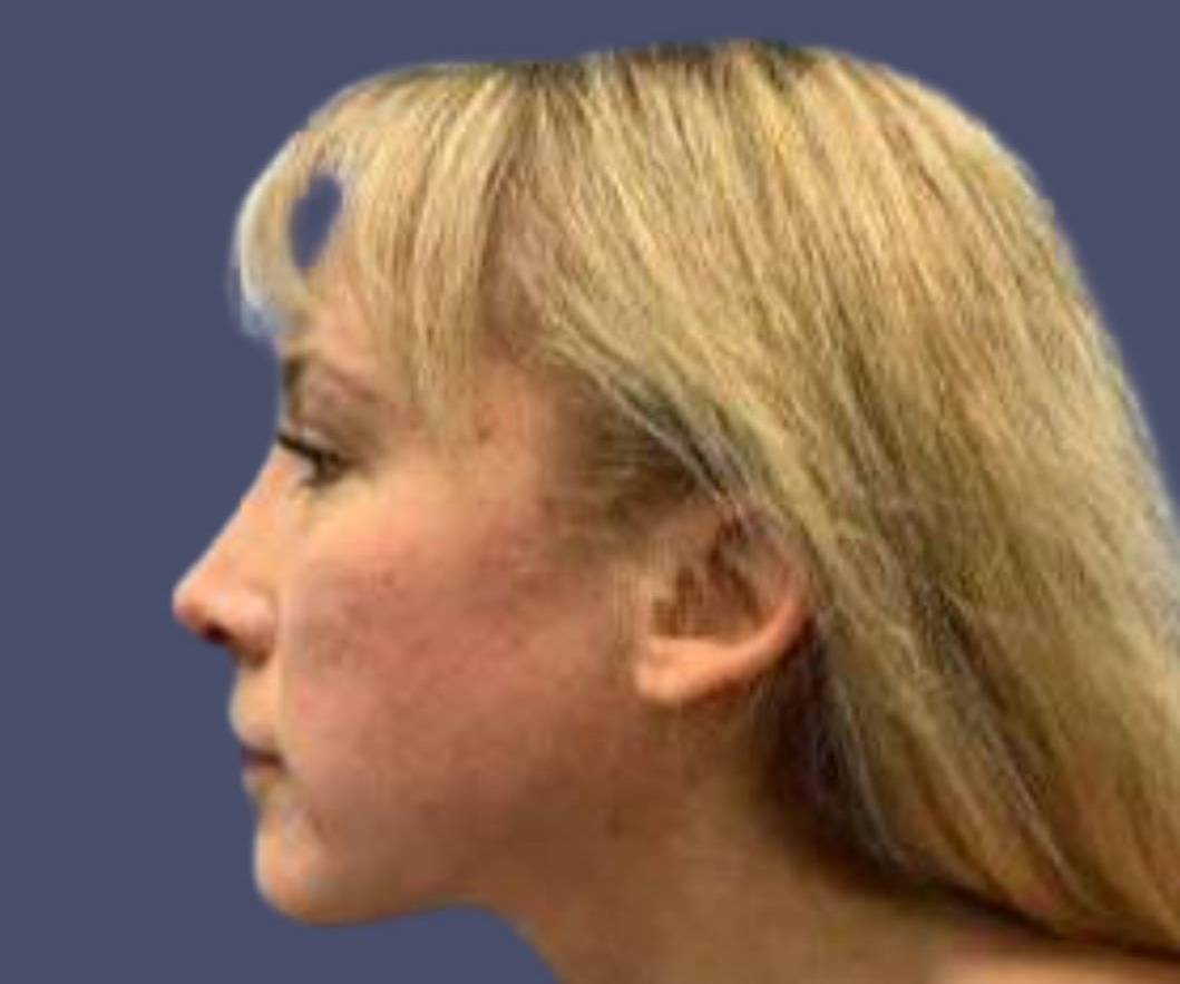 Submental Liposuction 3 After