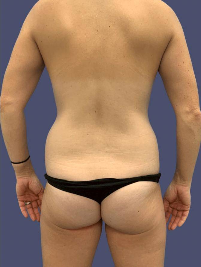Liposuction 9 - Posterior Flanks Before