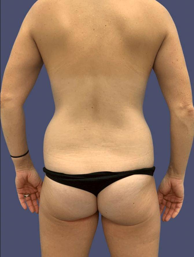 Liposuction 8 - Posterior Flanks Before