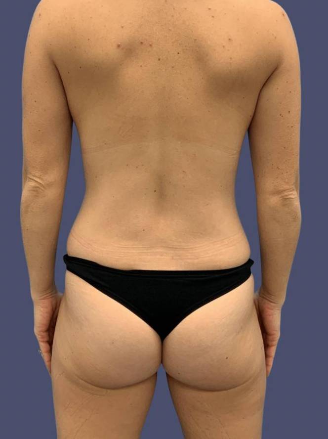 Liposuction 8 - Posterior Flanks After