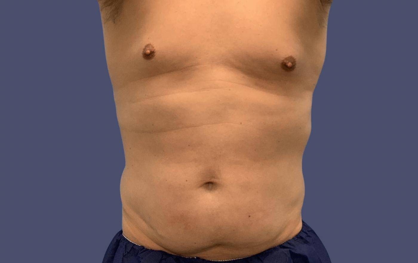 Liposuction 7 - Abdomen and Posterior Flanks Before