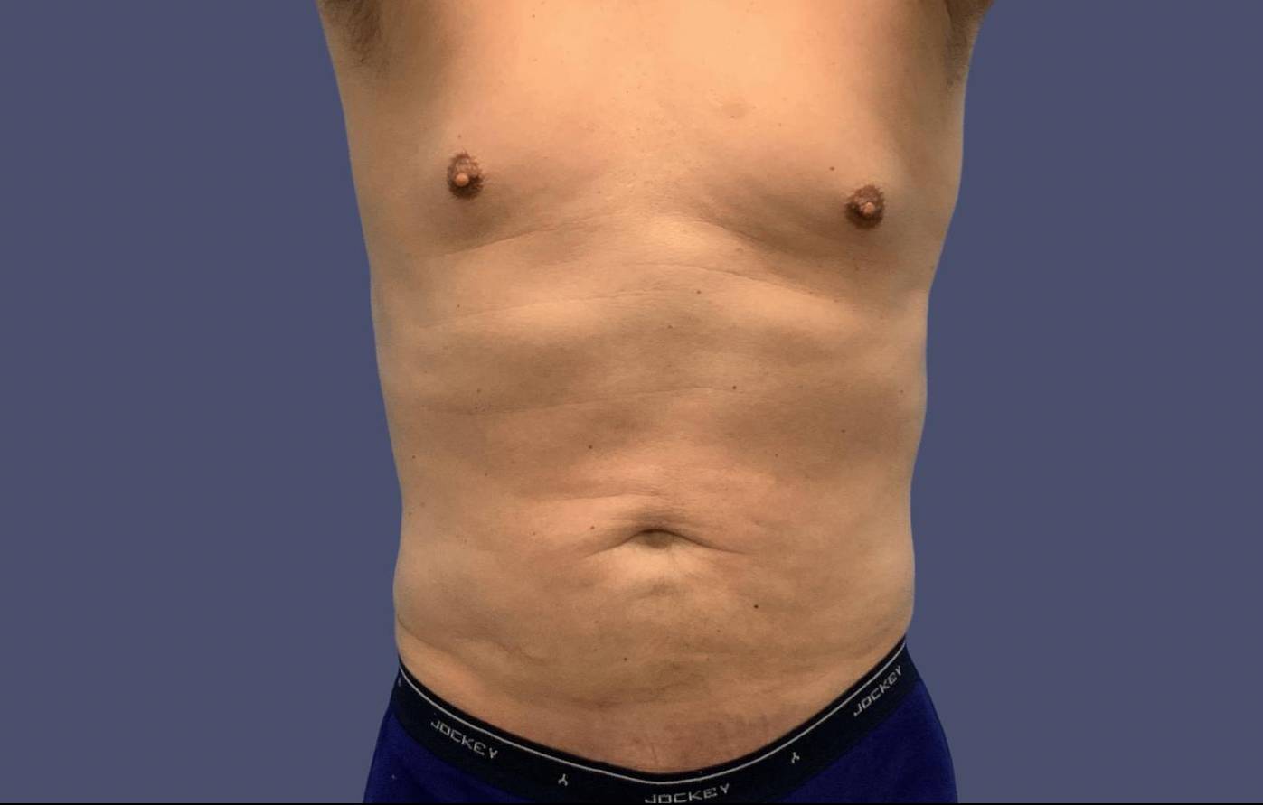 Liposuction 6 - Abdomen and Posterior Flanks After