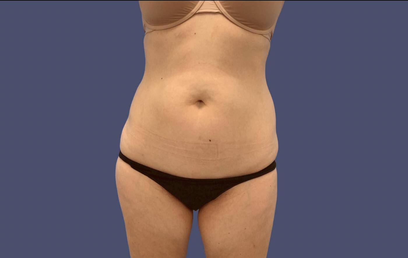 Liposuction 8 - Abdomen and Posterior Flanks Before