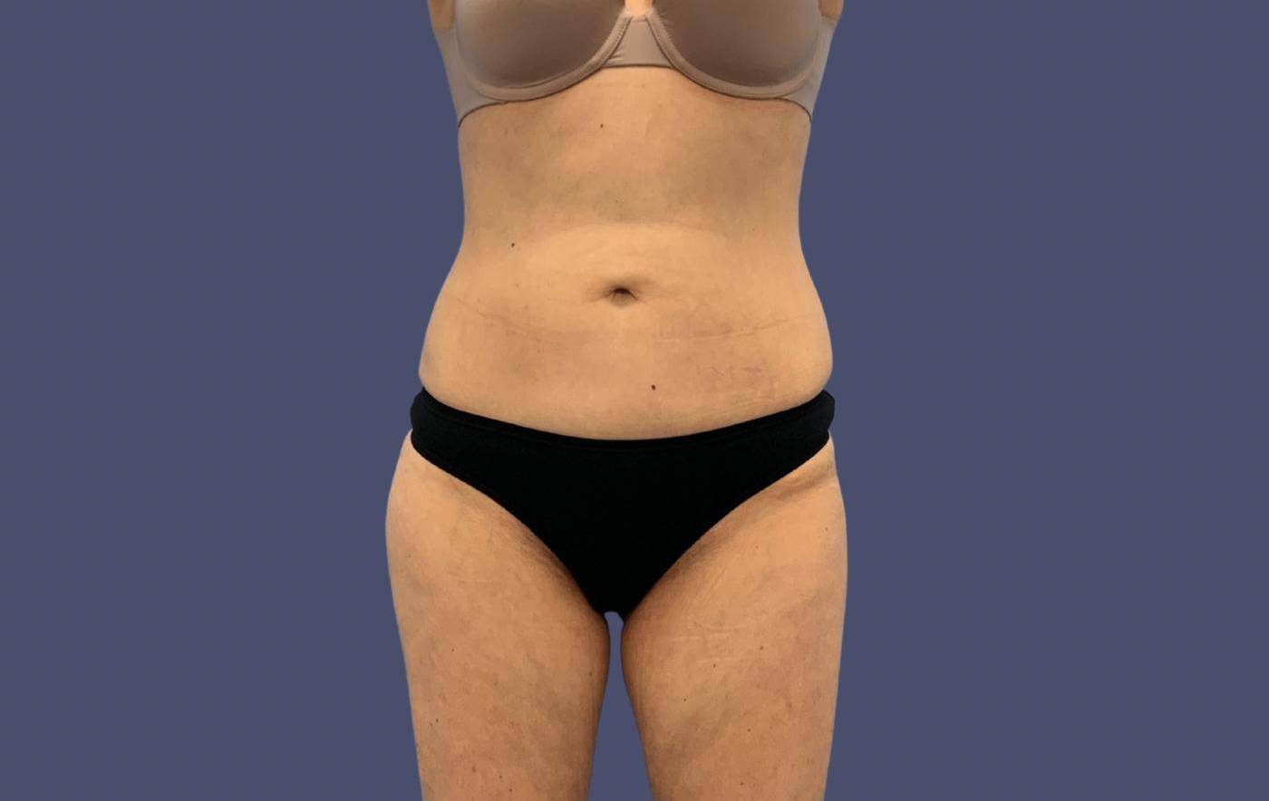 Liposuction 8 - Abdomen and Posterior Flanks After