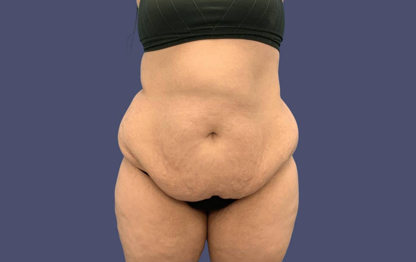 Abdominoplasty (Tummy Tuck) 4 Before