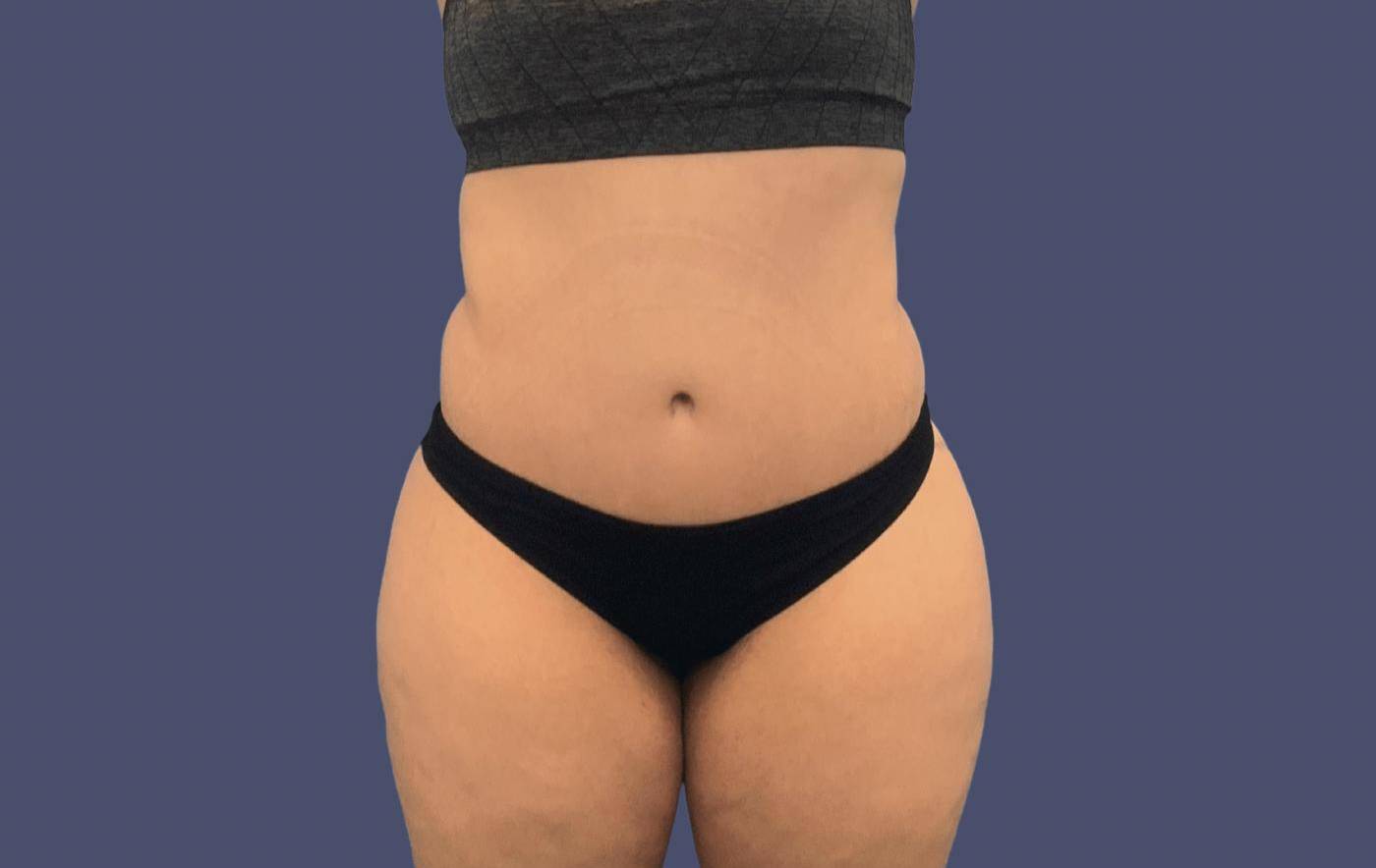 Abdominoplasty (Tummy Tuck) 4 After