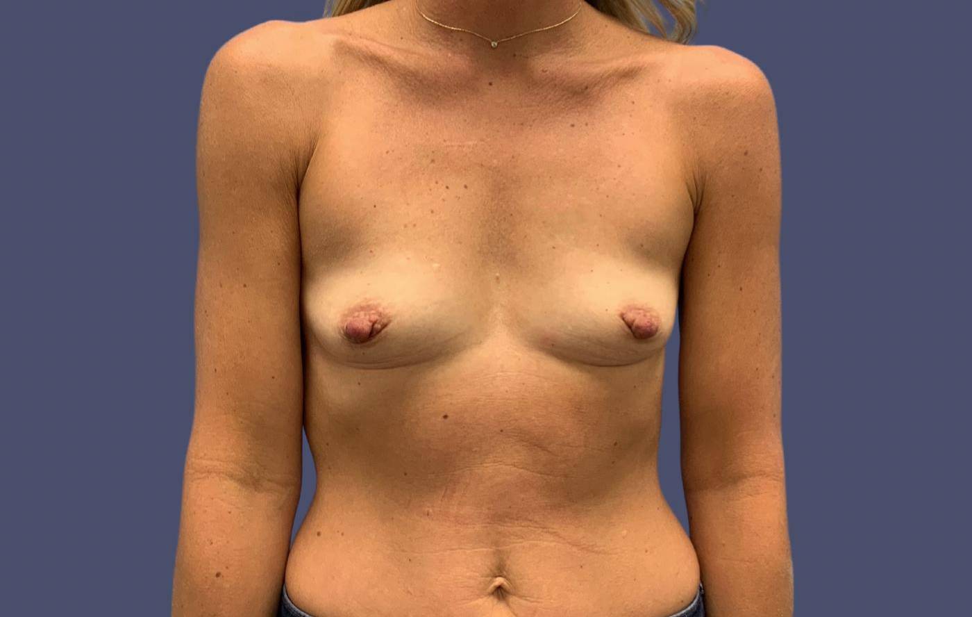 Breast Augmentation 43 Before