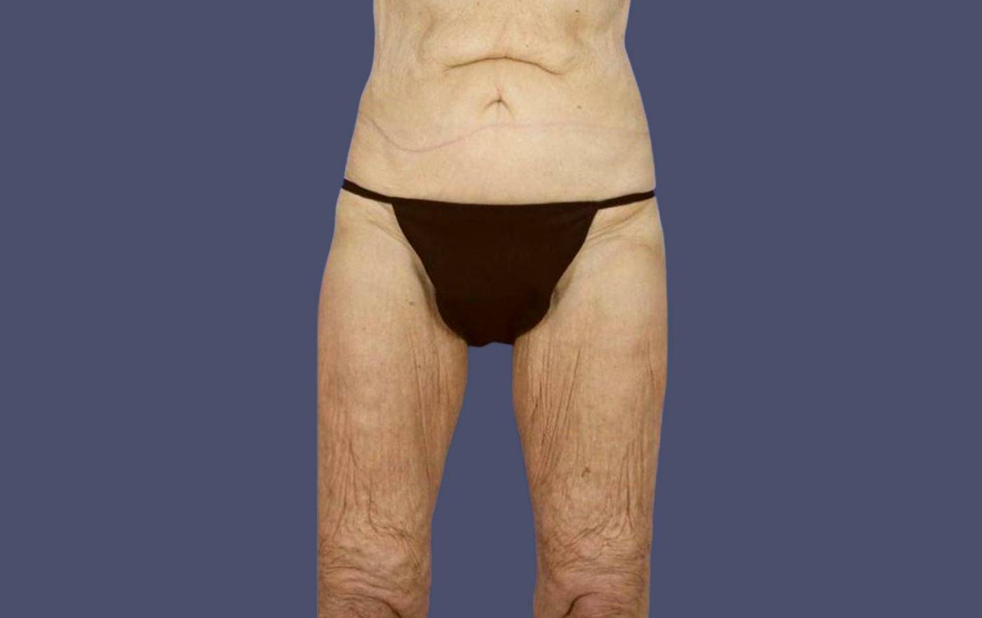 Thigh Lift 8 Before