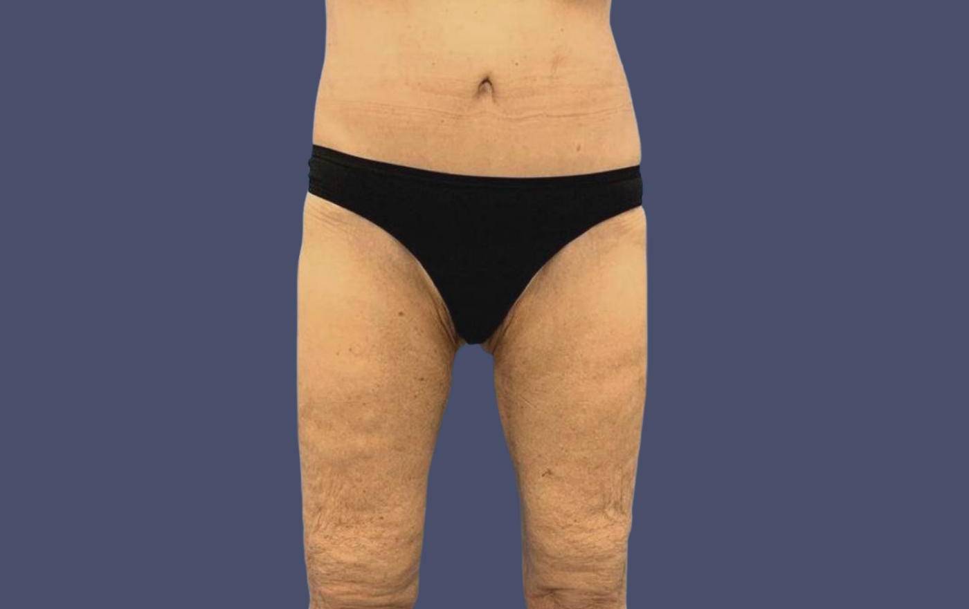 Thigh Lift 8 After