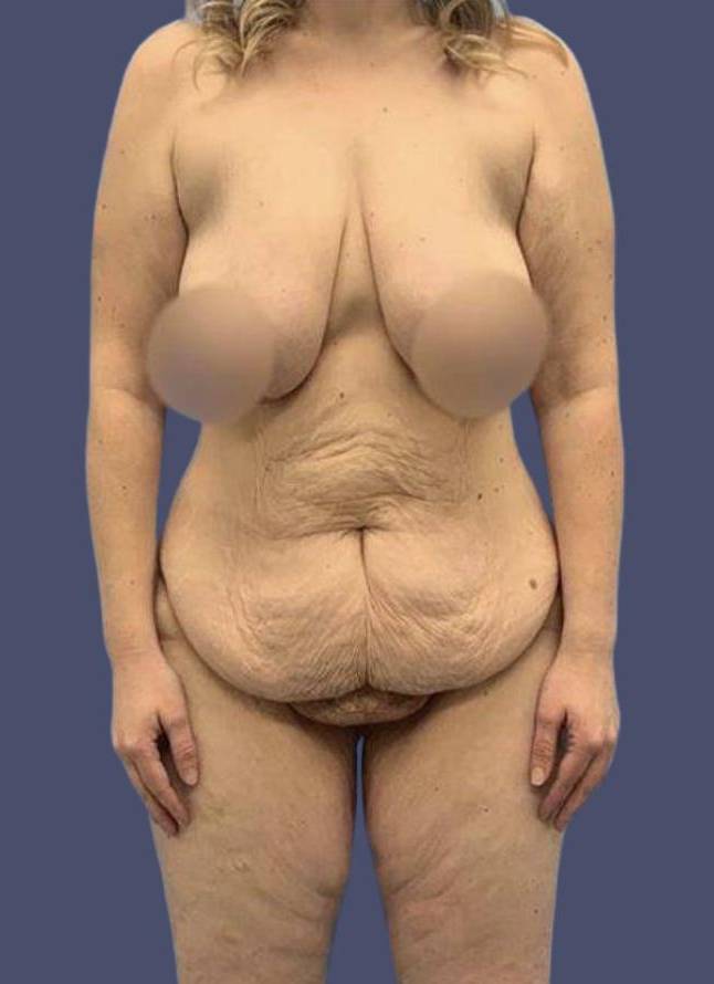 Mommy Makeover 20 Before