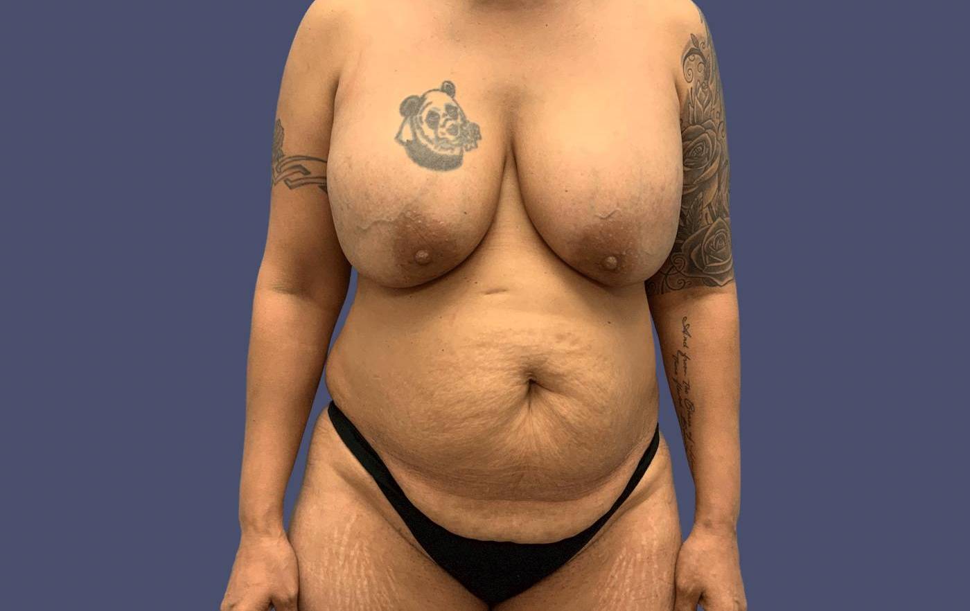Mommy Makeover 21 Before