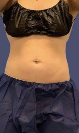 Coolsculpting 2 Before