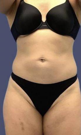 Coolsculpting 2 After