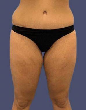 Coolsculpting 5 Before