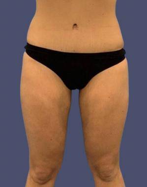 Coolsculpting 5 After