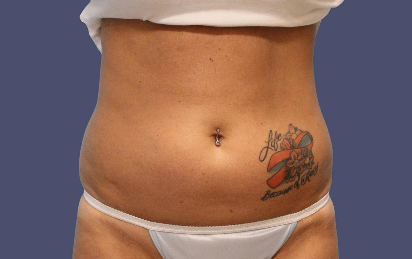 Coolsculpting 3 Before