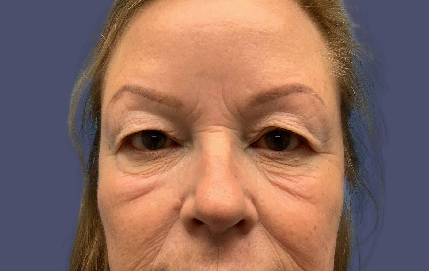 Upper Blepharoplasty 1 Before