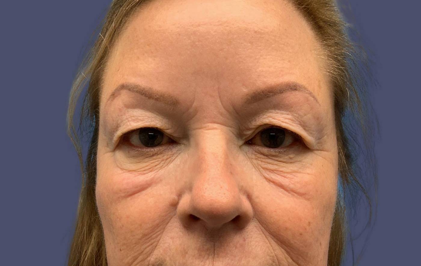 Blepharoplasty 1 - Upper Before