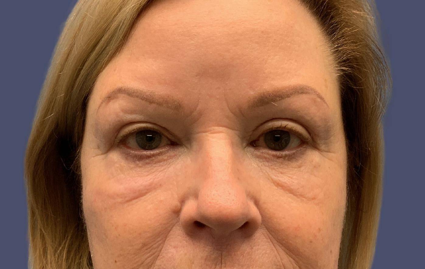 Upper Blepharoplasty 1 After