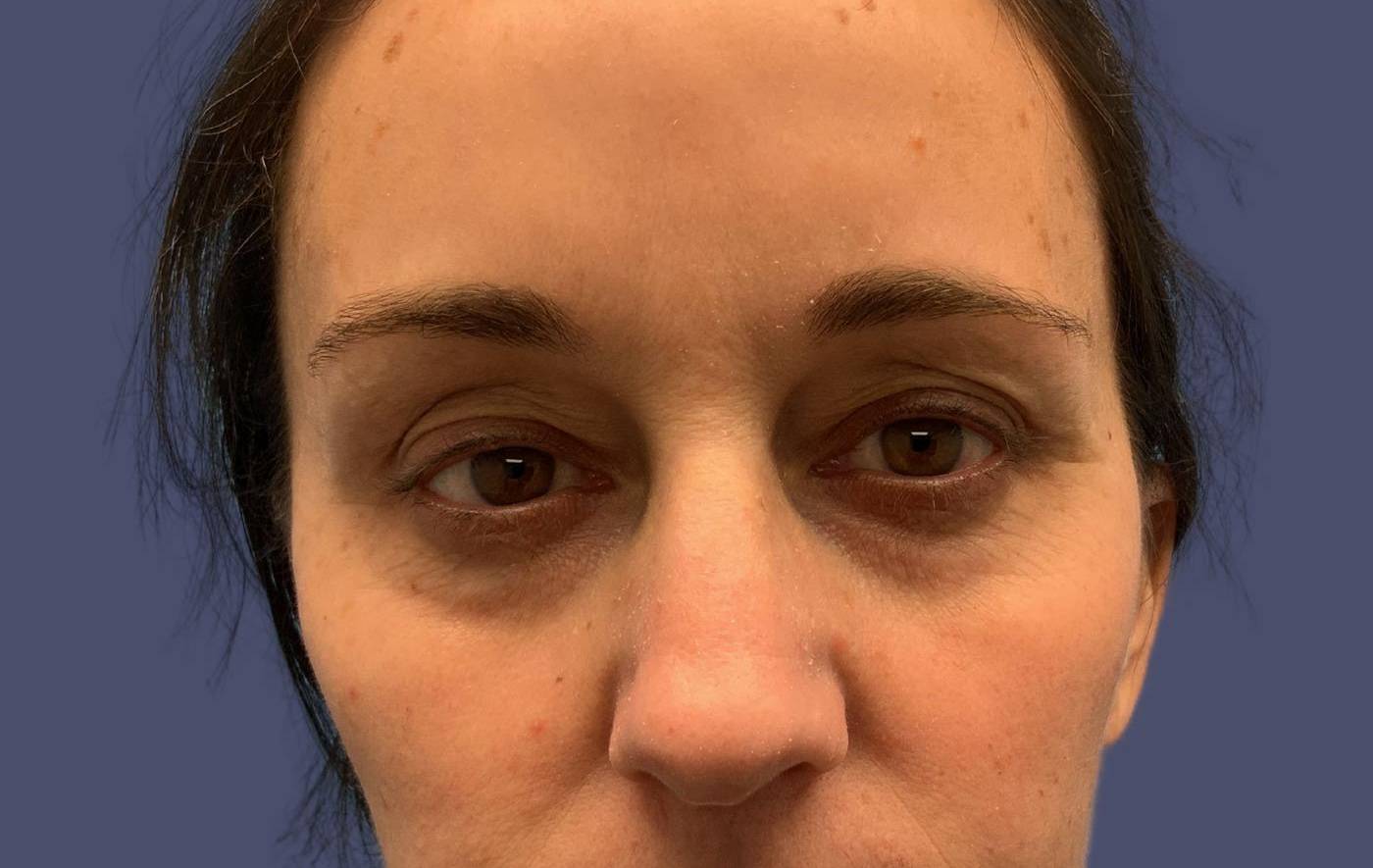 Blepharoplasty 18 - Upper Before