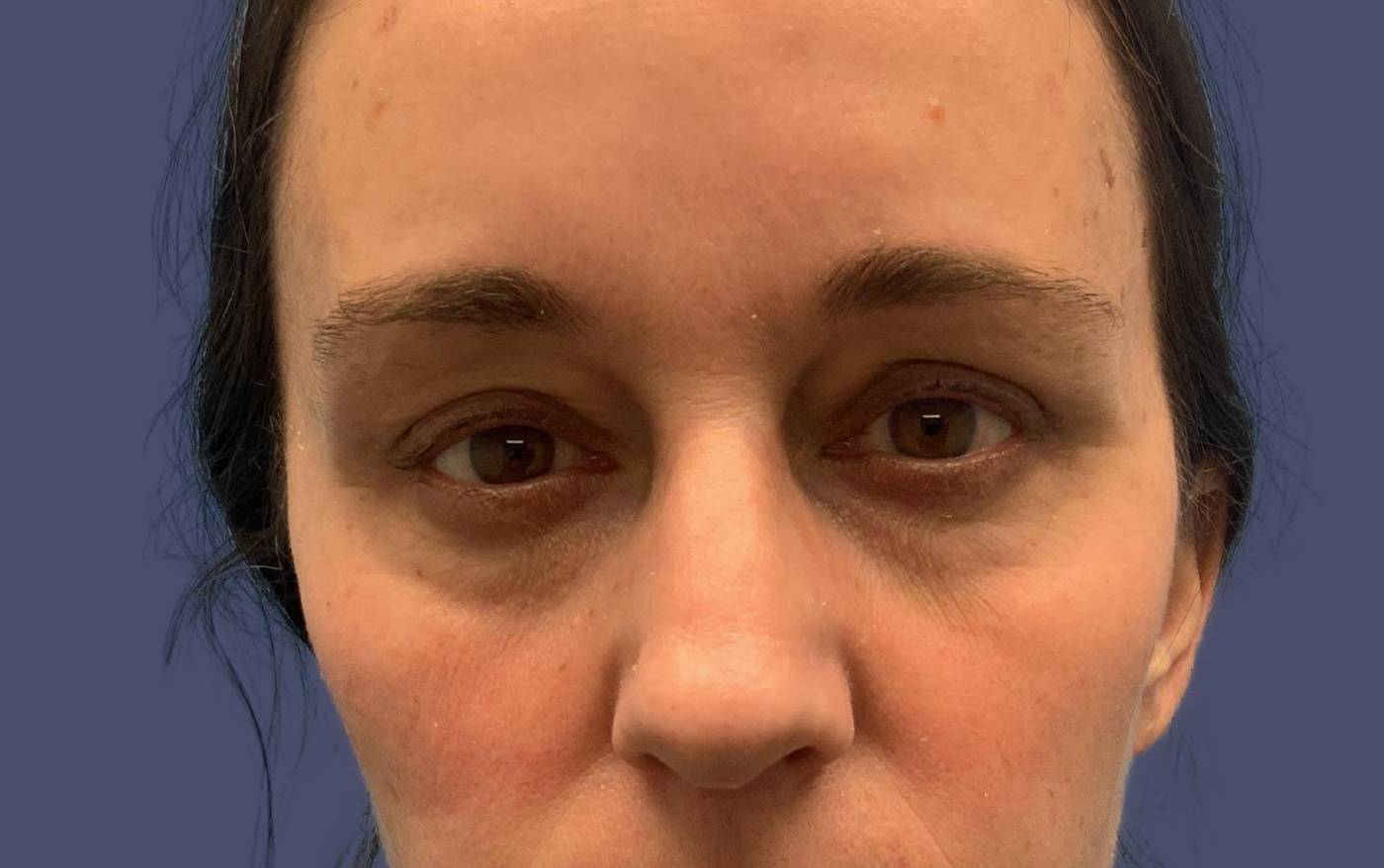 Upper Blepharoplasty 10 After