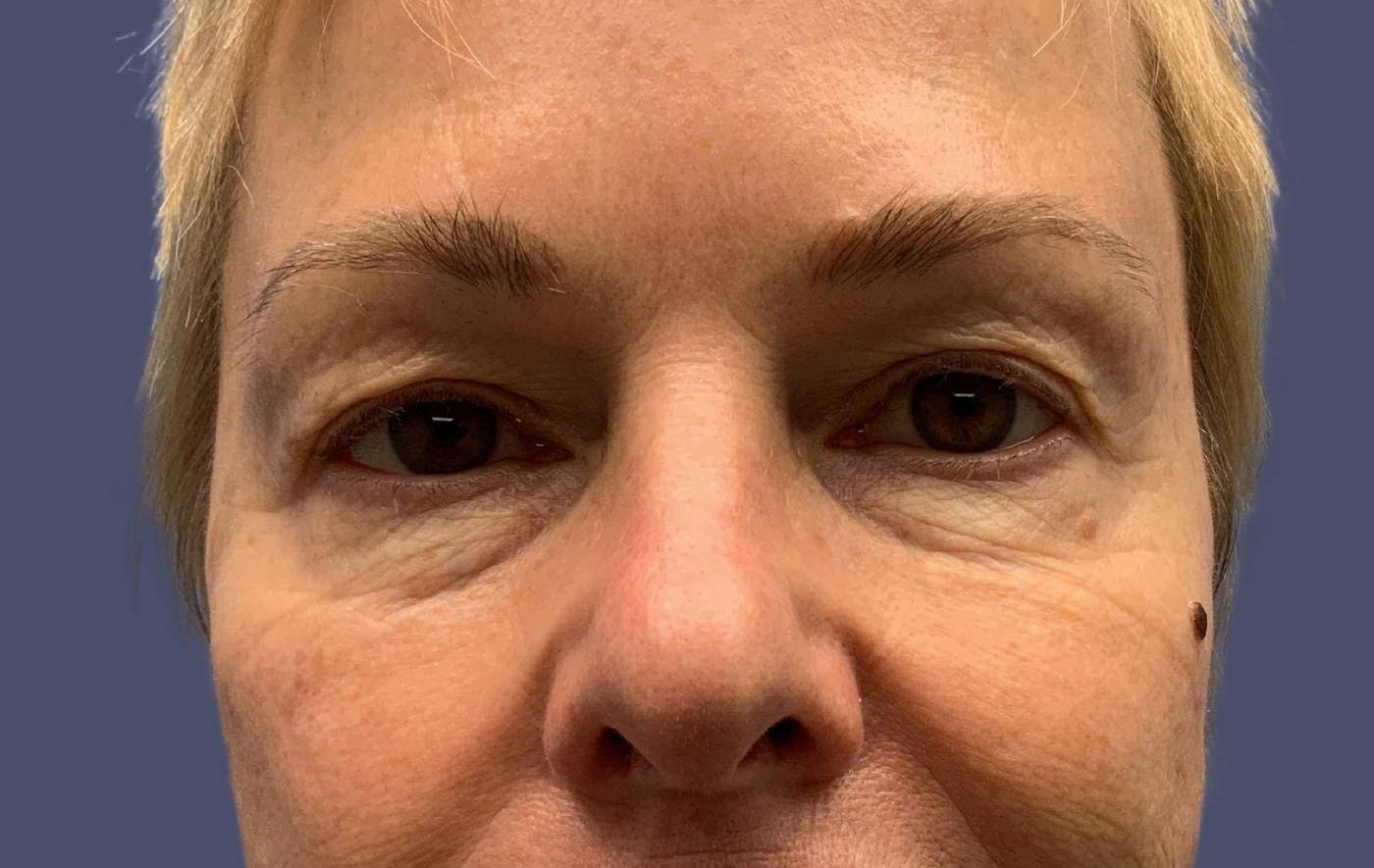 Upper Blepharoplasty 2 Before