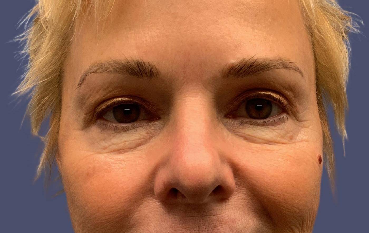 Upper Blepharoplasty 2 After