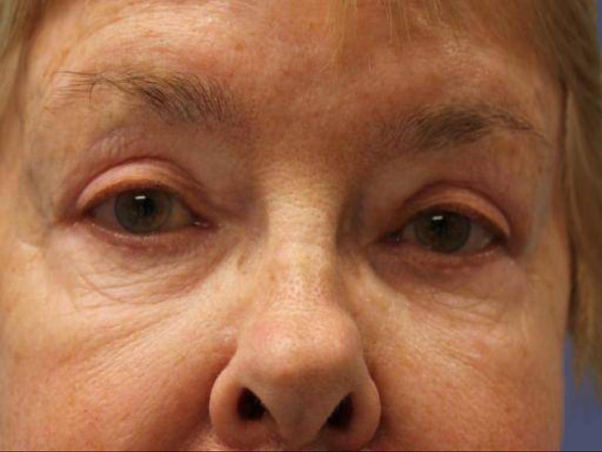 Upper Blepharoplasty 6 After