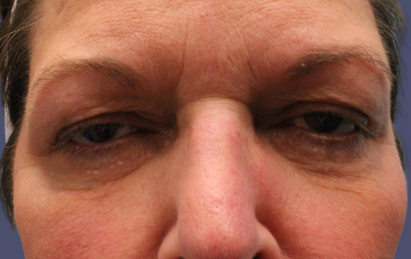 Blepharoplasty 19 - Upper Before