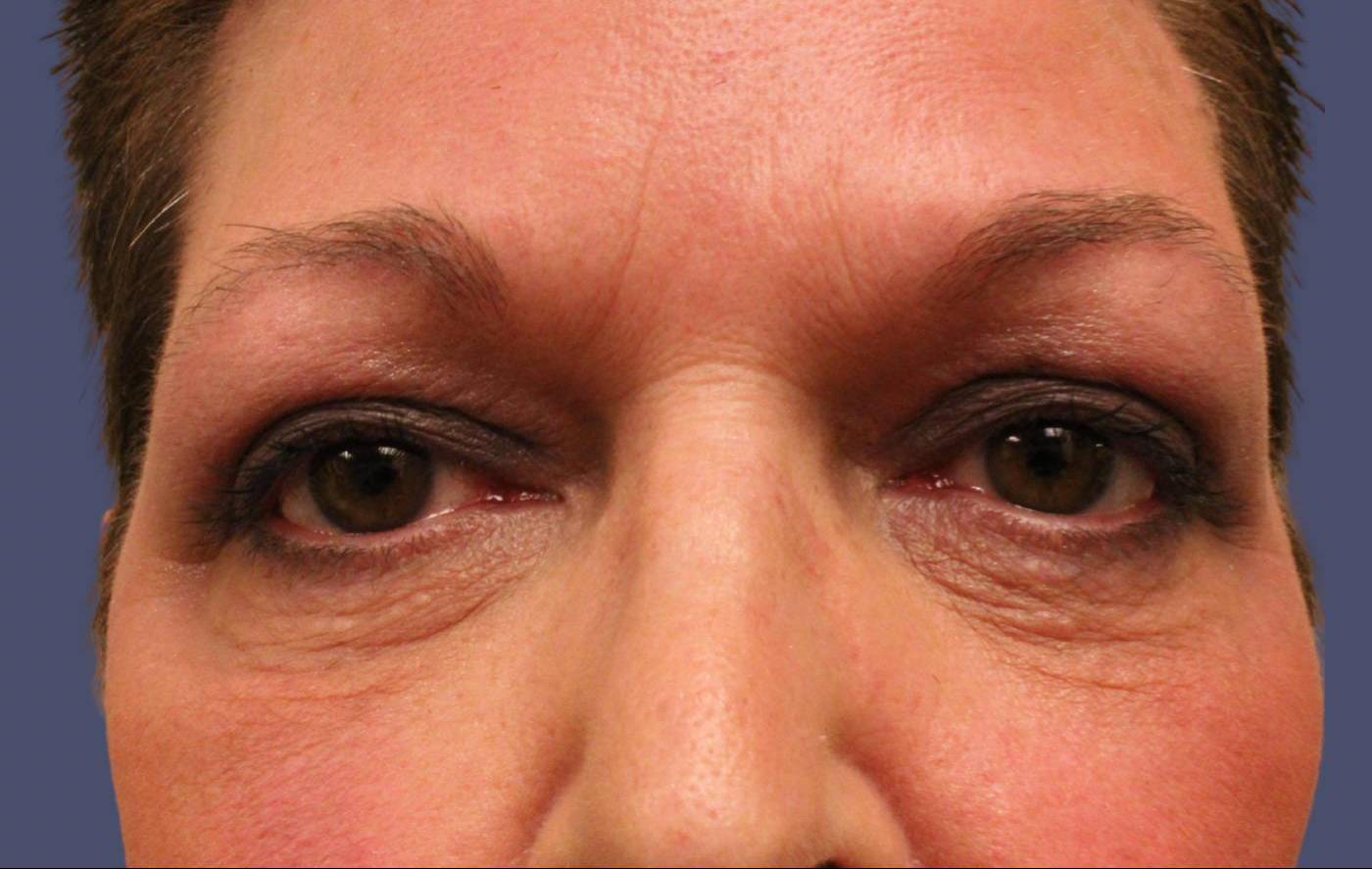 Upper Blepharoplasty 11 After