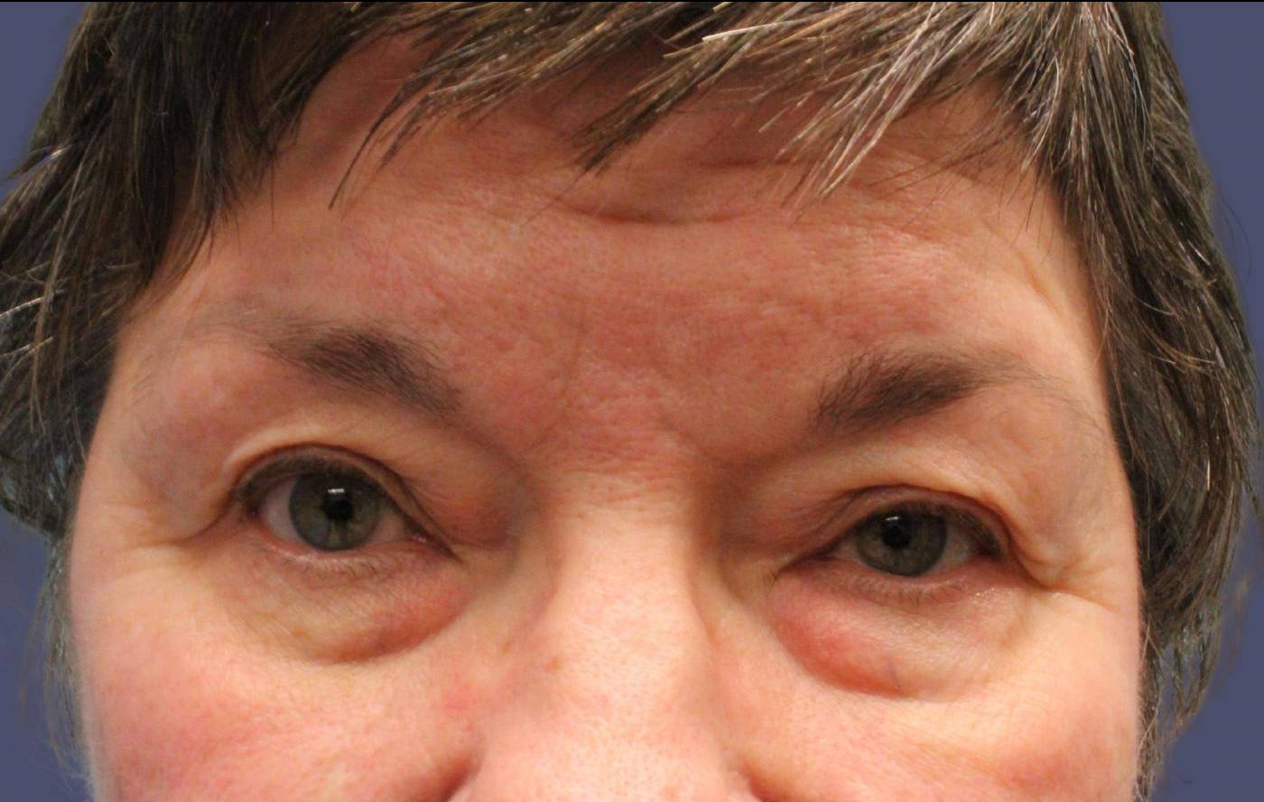 Blepharoplasty 20 - Upper Before