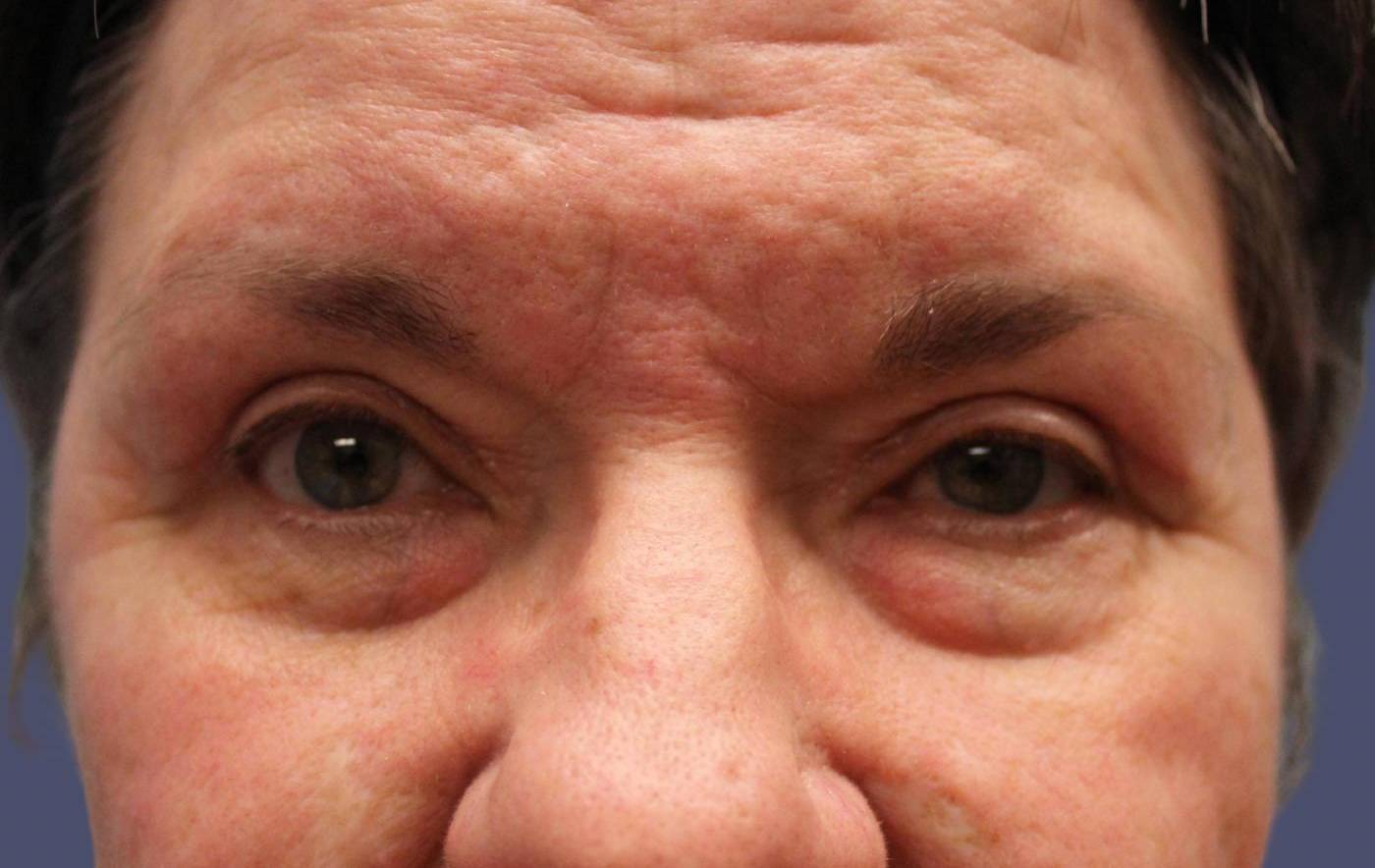Upper Blepharoplasty 12 After