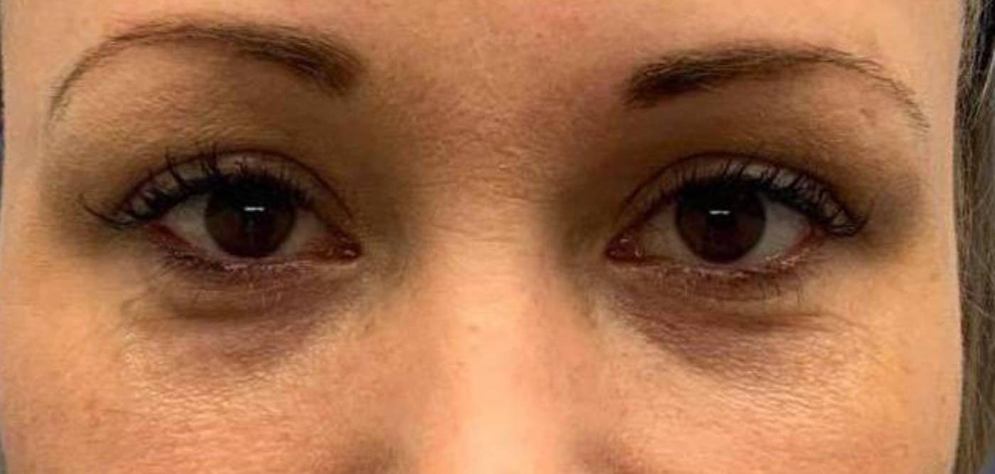 Dermal Fillers 6 - Tear Troughs Before