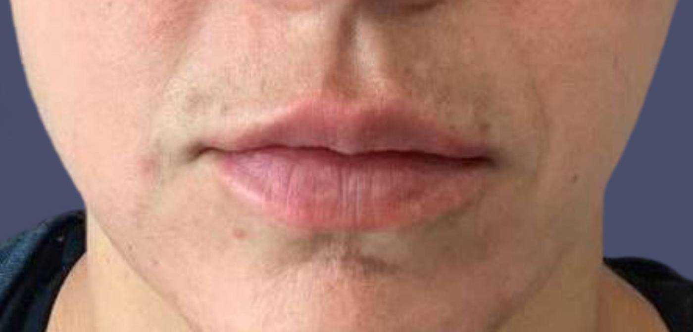 Lip Filler 16 After