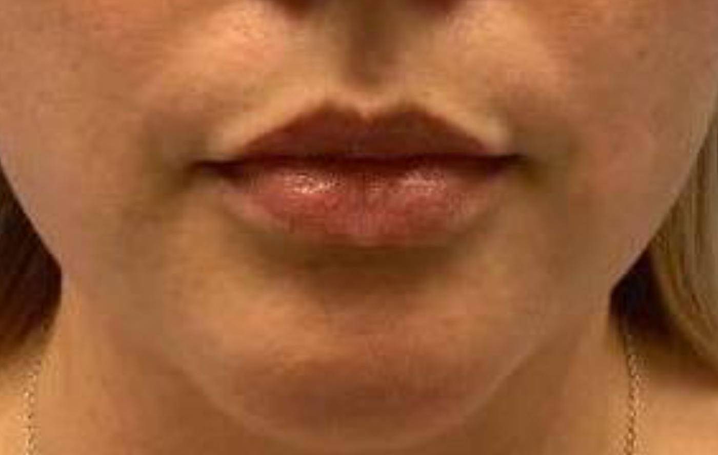 Lip Filler 13 Before