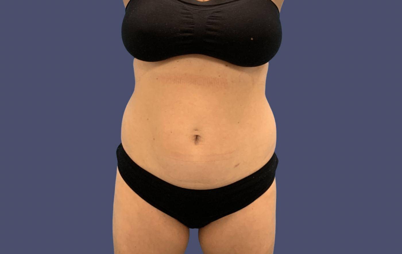 Coolsculpting 1 Before