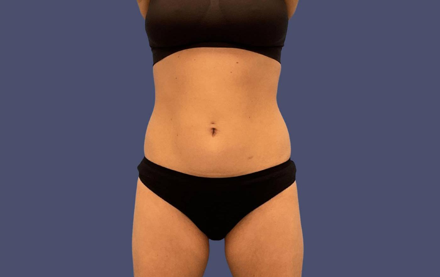 Coolsculpting 1 After