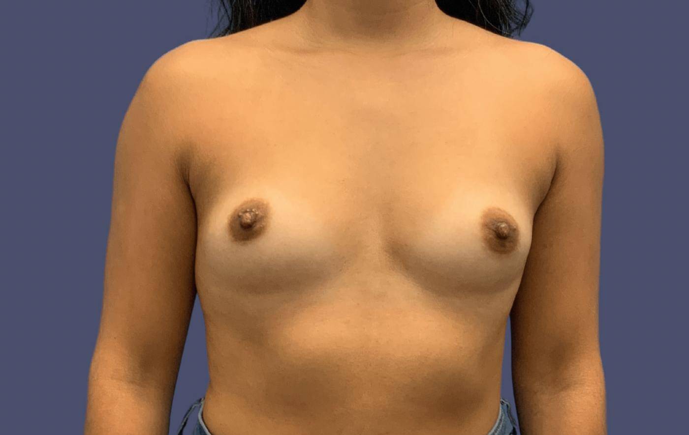 Breast Augmentation 34 Before