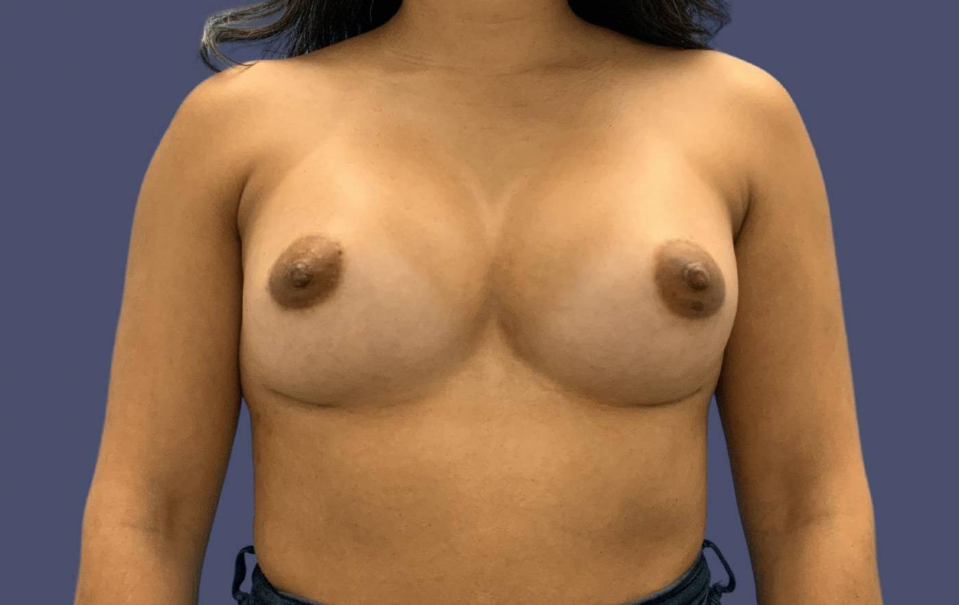 Breast Augmentation 34 After