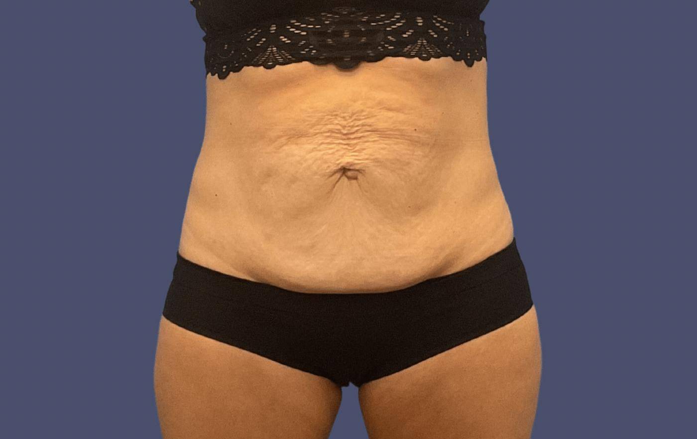 Abdominoplasty (Tummy Tuck) 4 Before